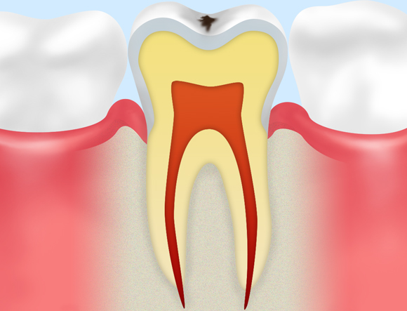 CO（初期虫歯）