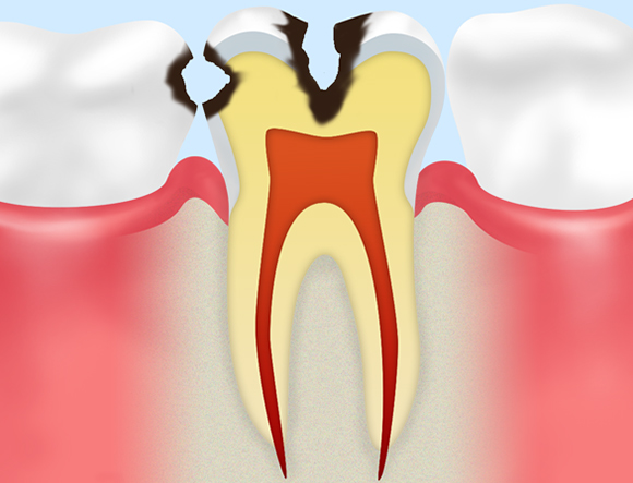 C2（象牙質の虫歯）