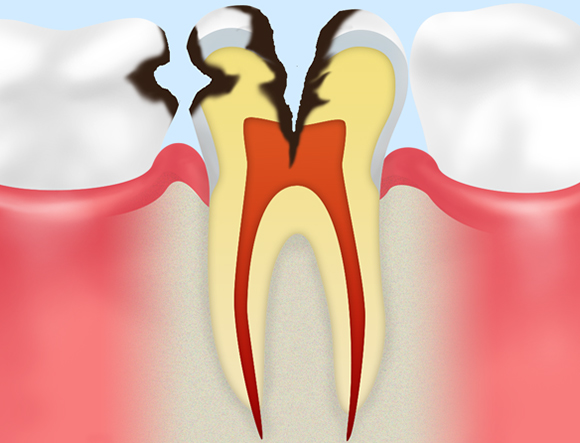 C3（神経まで達した虫歯）