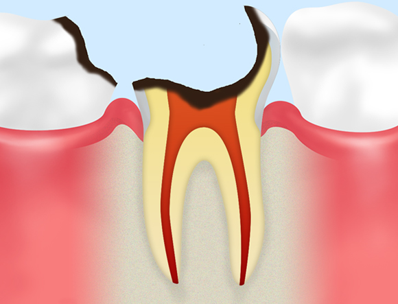 C4（末期の虫歯）
